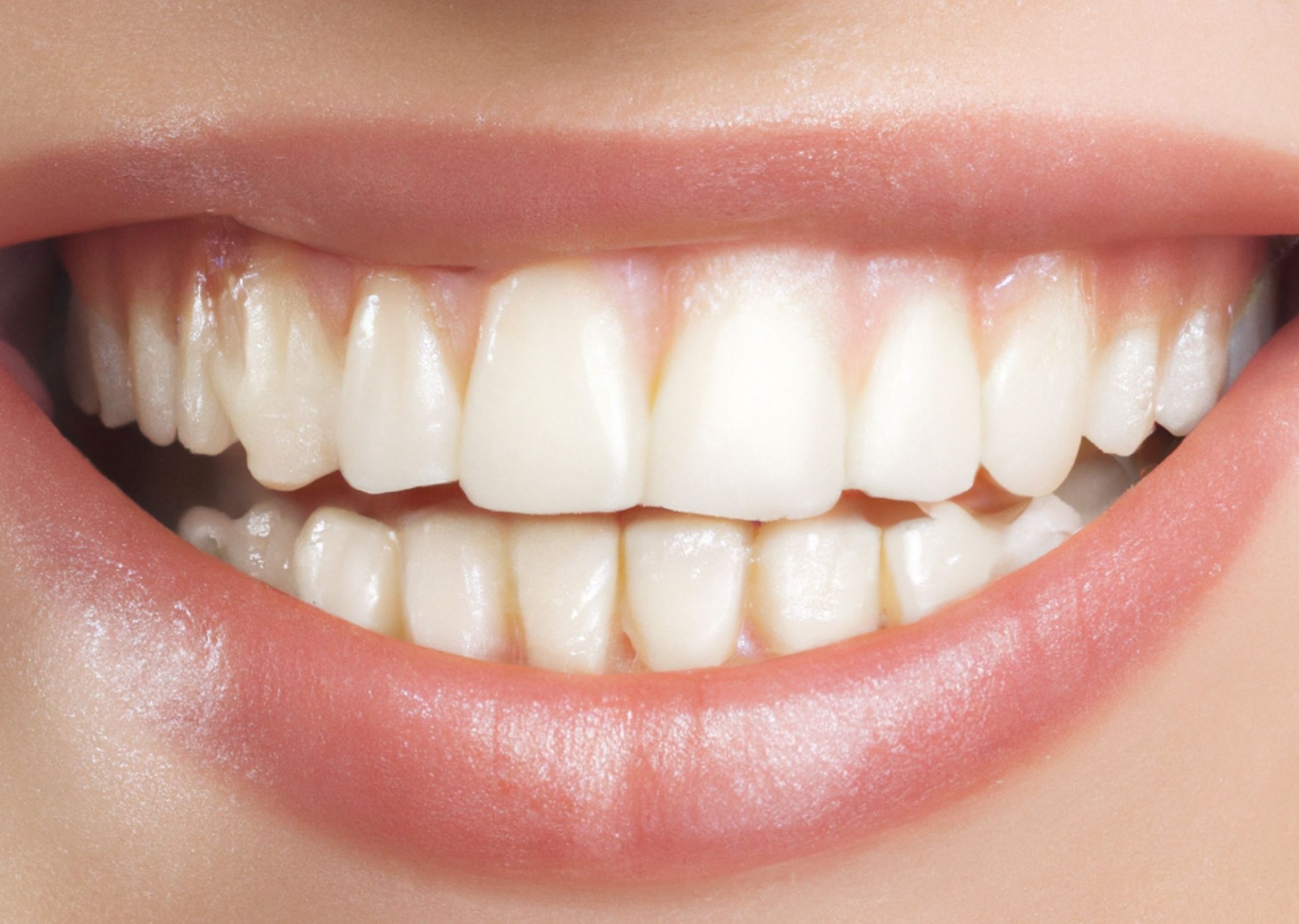 Patient smiling after root canal treatment